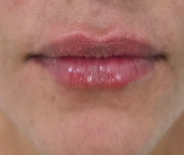 Después — Labios, procedimiento realizado por la Dra. Aura Celeste Avalos Alfonzo